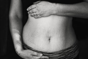 Lee más sobre el artículo Diástasis abdominal ¿Qué le ha pasado a mi abdomen?